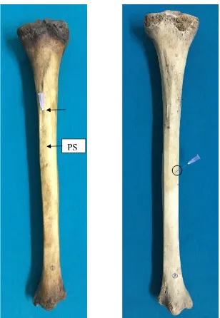 Fig. 15 – A variant tibia with an anteriorly directed single secondary nutrient foramen.