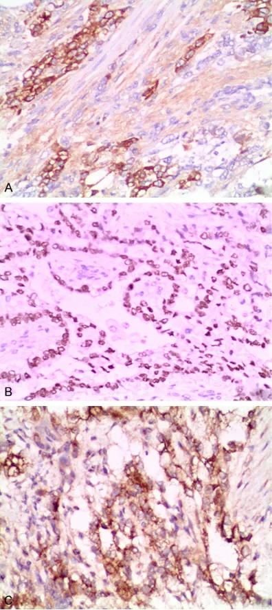 Figure 2. Envision immunohystochemical analysis: A. AFP positive expression in the yolk sac tumor com-ponent