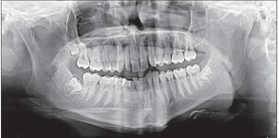 FIG 6 PRE-OPERATIVE OPG 