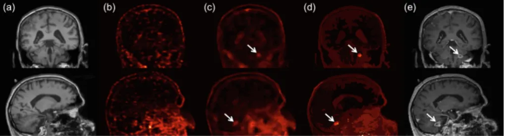 Fig. 6. Reconstruction of low-count clinical [ 18 F]Choline data by (b) MLEM (no prior), (c) KEM and (d) the proposed SIR method shown with the same colour scale