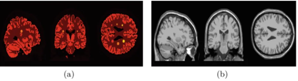 Fig. 1. Simulated brain phantom with lesions (voxel size 1 × 1 × 1 mm 3 ). (a) the BrainWeb brain phantom composed of grey matter, white matter and 6 lesions (various sizes and uptake values); (b) the corresponding T1-weighted MR image used as the anatomic