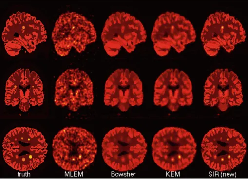 Fig. 2. PET images reconstructed by MLEM (no prior), Bowsher, KEM and the pro- pro-posed SIR at low-count level (1e7) with the same colour scale