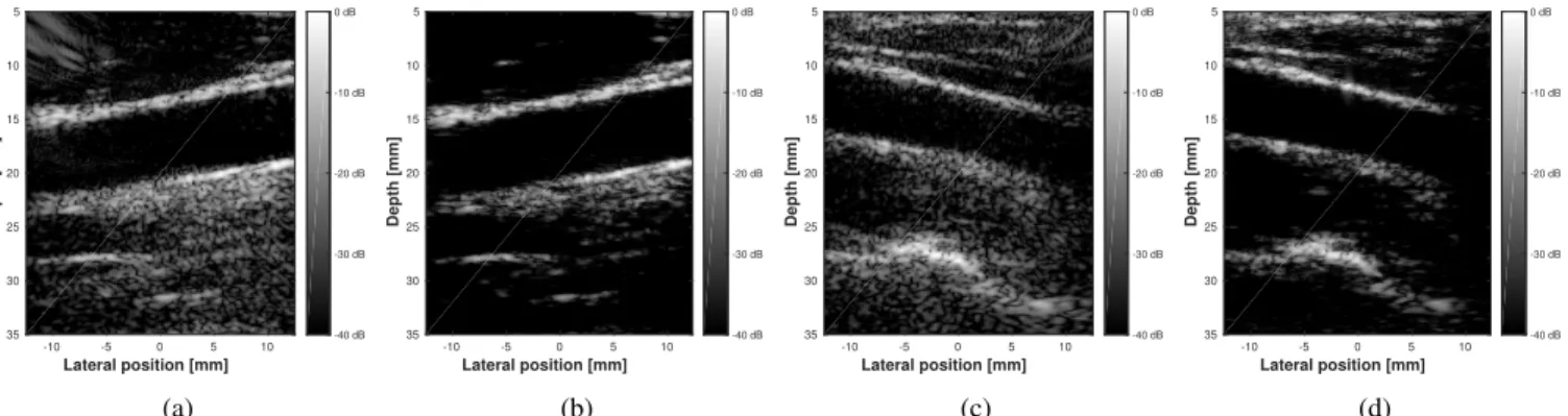 Fig. 9: B-mode images of the in vivo carotids for 1 PW insonification reconstructed with DAS ((a) and (c)) and with the compressed beamforming ((b) and (d)) coupled with the CMIX strategy and 20 % measurements.