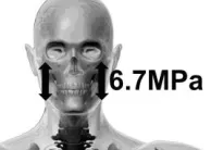 Figure 1 illustrates the loading of a cranial bone flap. In the skull we do not have any significant physiological loading