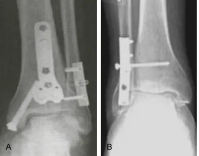 Figure 1. Internal fixation of ankle joint fracture com-bined with tibiofibular syndesmotic injuries