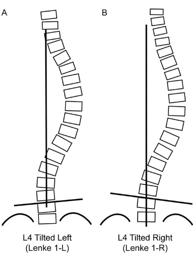 Figure 1. Lenke 1 scoliosis is divided into L type and R type according to inclination of the L4 vertebra