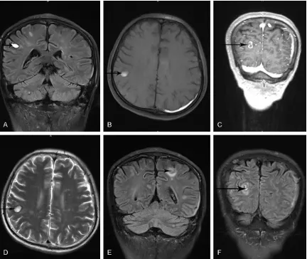 Figure 1. Intracranial MRI scan with enhancement, February 5, 2015. A-F. Show ring enhancement of the right frontal lobe