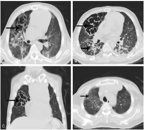 Figure 2. CT scan with enhancement, of lower and upper abdomen and chest, February 5, 2015