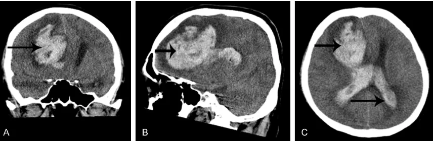 Figure 4. Intracranial CT scan, March 3, 2015. A-C. Show a hemorrhage in the right frontal lobe, breaking into the body of the right ventricle, the third ventricle, the left lateral ventricle angle, the mid-brain aqueduct and the fourth ventricle