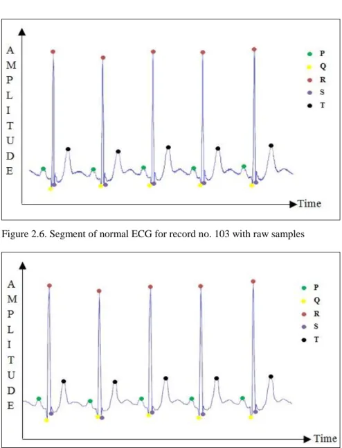 Figure 2.6 depicts part of the raw ECG from Record no. 103 of the MIT-BIH Arrhythmia database