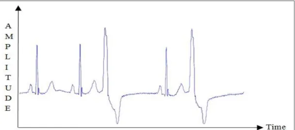 Figure 2.20. Segment of PVC ECG for record no. 119 with raw samples