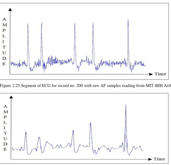 Figure 2.25.Segment of ECG for record no. 200 with raw AF samples reading from MIT-BIH Arrhythmia database 