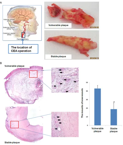 Figure 1. Compared to the morphological and pathological characteristics between vulnerable and stable plaque.The patients in this work were all performed with carotid endarterectomy (CEA)