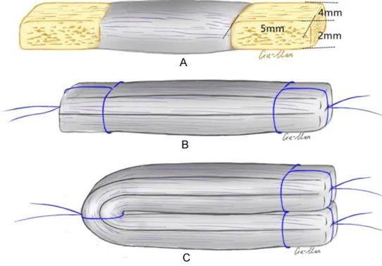 Figure 1. A: The B-ACL-B allograft, B: The 2-stranded ST autograft, C: The 4-stranded ST autograft.
