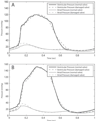 Figure 4. Pressure waveform comparisons: A) normal and damaged valve with pLVP  of 120mmHg; B) normal and damaged valve with pLVP of 150mmHg 