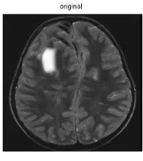 Figure 1. MRI of Human Brain. (The Presence of a Tumor Towards The left side) 