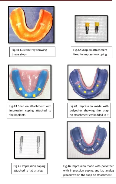 Fig.41 Custom tray showing 
