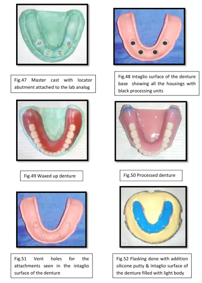 Fig.48 Intaglio surface of the denture 