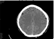 Figure 13: Sample 7 after applying the process (Edge detection and segmentation) no tumor region has been detected