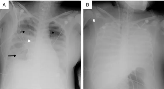 Figure 1. Anteroposterior chest radiographs obtained with portable bedside unit in a 38-year-old man with AI H7N9 from survival group show extensive bilateral infiltrates of patchy opacity (black arrowhead), GGO (short arrow), and consolidation (long arrow