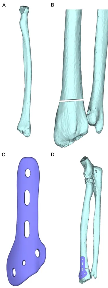 Figure 1. Three-dimensional stereo model after non-bridge external fixation of distal radius fracture