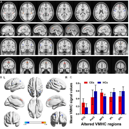 Figure 1. Group comparison of interhemispheric functional connectivity between CE patients and HCs