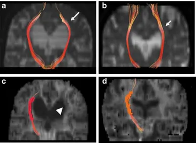 Fig. 3 Anisotropy color-coded MRI tractography of the corticospinal tract (CST) at the 