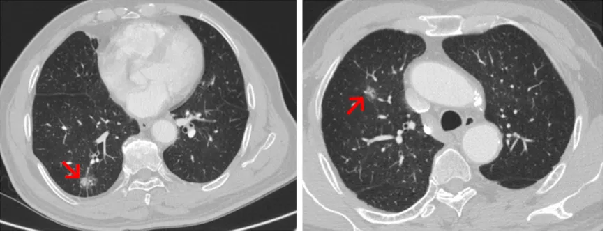 Figure 1. Chest CT showing a case of synchronous multiple primary lung cancer (SMPLC) manifested with two differ-ent ground-glass opacity (GGO) tumors at the upper and the lower lobes of the right lung, respectively.