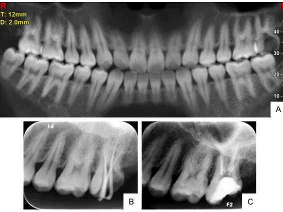 Figure 1. A. Preoperative panoramic radiograph of tooth No. 27. B. Working length determination