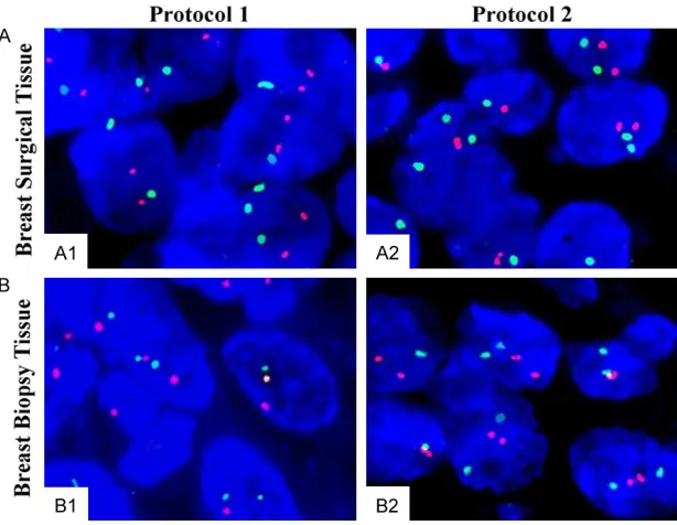 Figure 3. Fluorescent in situ hybridization (FISH) visualization of paired-breast sam-ples.dehydration protocol 1 (A) and protocol 2 (B)