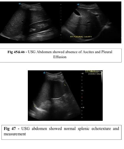 Fig 45&46 - USG Abdomen showed absence of Ascites and PleuralEffusion
