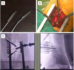 Figure 1. A. The improved nerve retractor has prefabricated pipeline in the surface of the nerve stripper or hook, and the kirschner wire can pass through it to fix the retractor on the vertebral body
