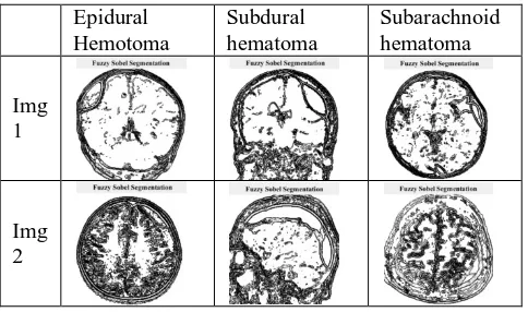 Fig 8 Canny Edge Segmentation 