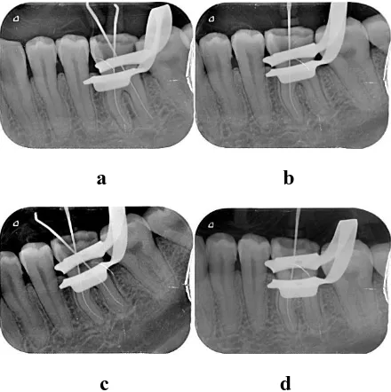 FIGURE VII: RADIOGRAPHS TAKEN AT “0.0mm and 0.5mm” READINGS FOR THREE DIFFERENT APEX LOCATORS BEFORE BIOMECHANICAL 