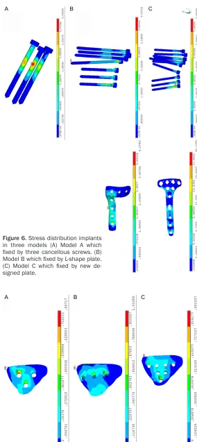 Figure 6. Stress distribution implants in three models (A) Model A which 
