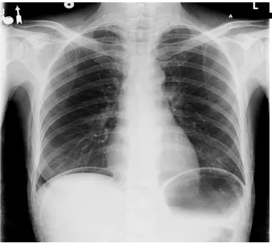 Fig 4: chest x-ray showing air under diaphragm 