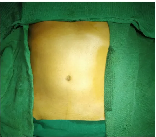 Fig 6: skin and subcutaneous tissue opened through Midline 