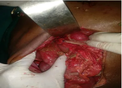 Fig 11: Picture showing primary closure of perforation 