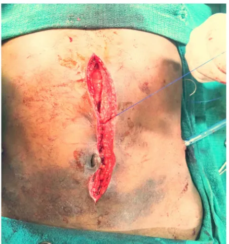 Fig 13: Bilateral tube drain kept 