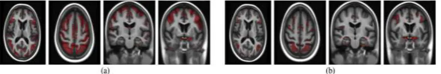 Fig. 5.    Cortical surface reconstructions channel) cortical regions better than the MRI-based registration