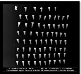 Fig 1: 75 Single rooted mandibular premolar 