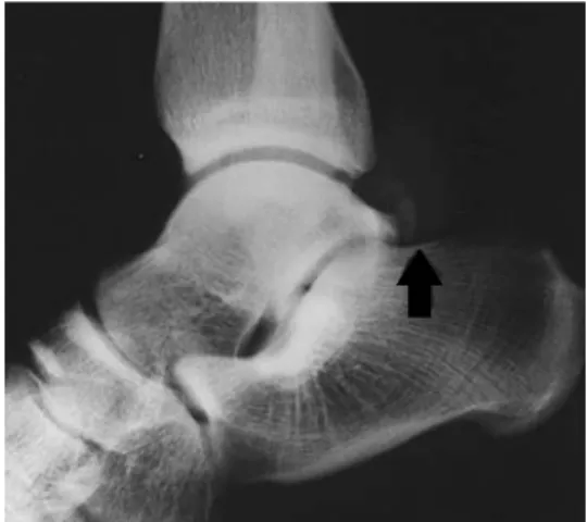 FIGURE 6. Lateral view of the ankle showing a fracture of the lateral tubercle of the  poste-rior process of the talus