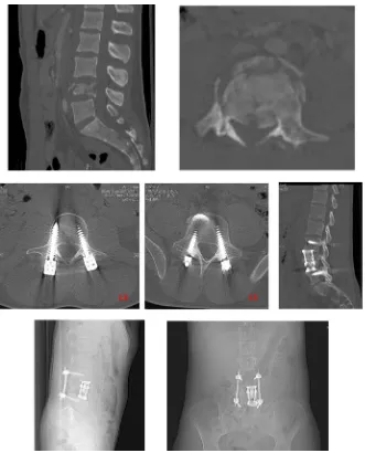 Figure 3. Posterior percutaneous osteosynthesis of a Burst L4 fracture by Medtronic Sex-tant (L3-L5) + L4 corporectomy by left lombotomy and placement of a V-LIFT (strycker)
