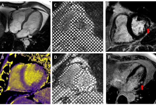 Fig. 2    CMR imaging from a single patient with GPA: SSFP cine  imaging (a), Native T1 map with colour scale from 1000 ms (purple)  to 2000 ms (yellow) (b), grid tags at end diastole (c) and end systole 
