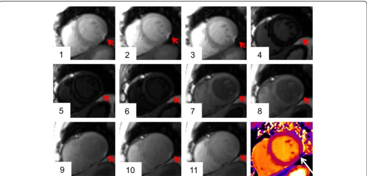 Figure 6 T 1 mapping artifact. Susceptibility artifact in the inferolateral wall of the midventricular plane (red arrow)