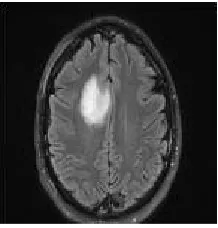 Fig. 1 Brain Tumor Image 
