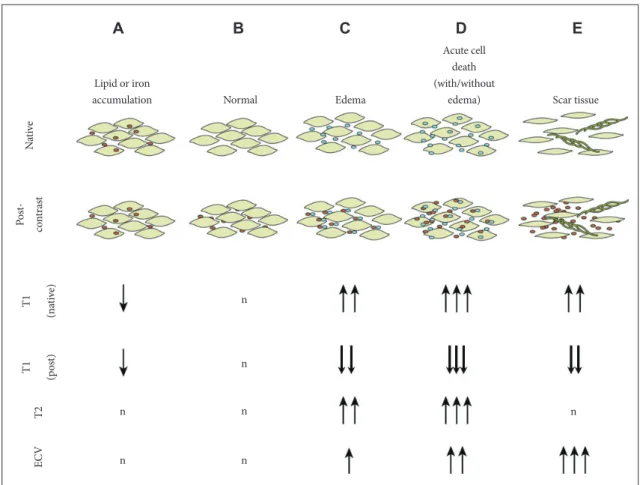 Fig. 1. A schematic representation of tissue changes in T1 measurements. (A) Lipid or iron accumulation (red dots) reduces native T1 val- val-ues, irrespective of the T1 accuracy or T2 sensitivity of a given sequence