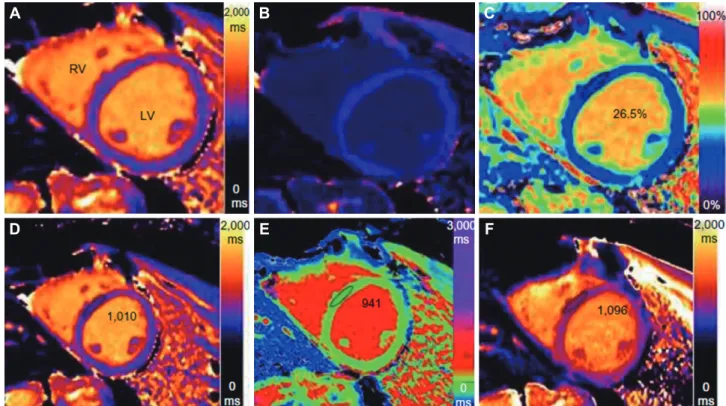 Fig. 2. Representative images of T1 mapping. (A) Native T1 MOLLI map (myocardial T1 1010 ms)