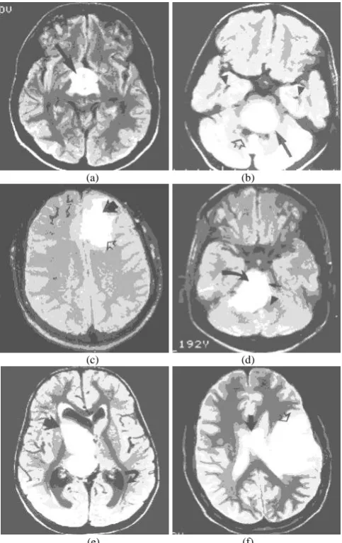 Fig. 4. (a) Segmented MRI2, (b) segmented MRI3, (c) segmented MRI4, (d) segmented MRI5, (e) segmented MRI6, (f) segmented MRI7