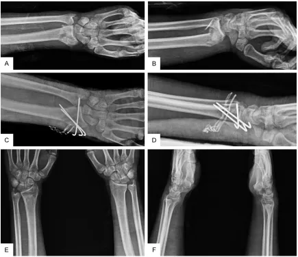 Figure 2. Comparative radiographs (with contralateral site) of patient with AO type C1 distal radius fracture of the left side